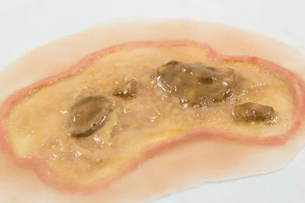 Burns, Boils & Ulcers